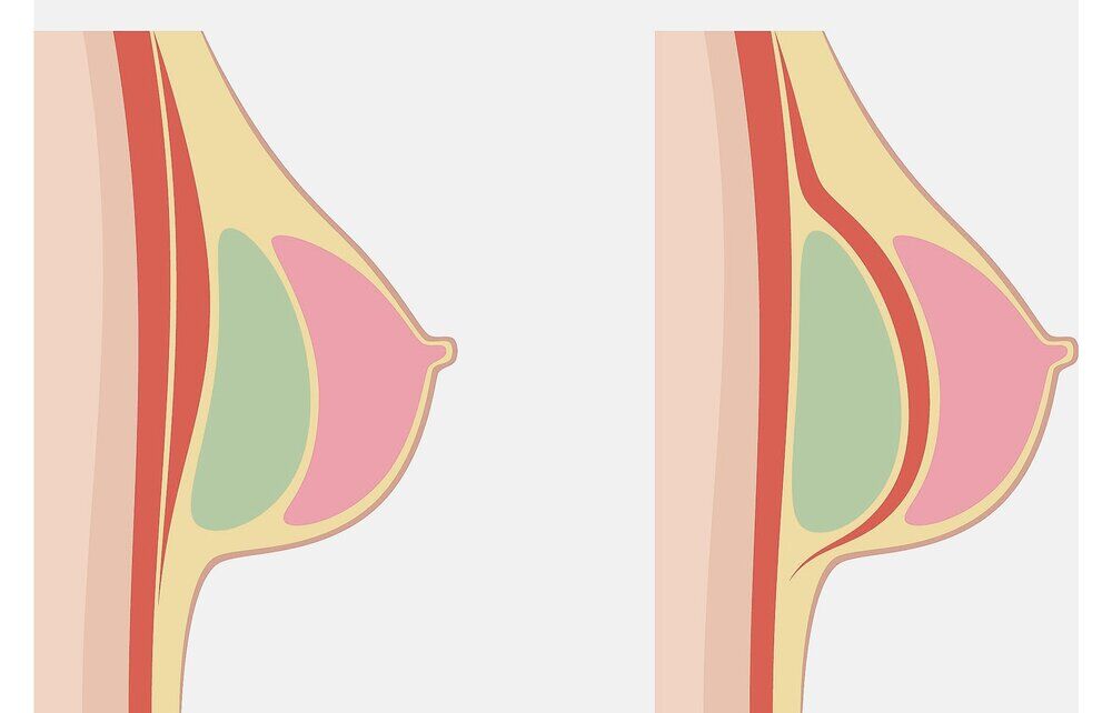 diagram of breast implant